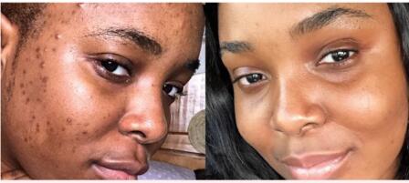 turmeric soap before and after